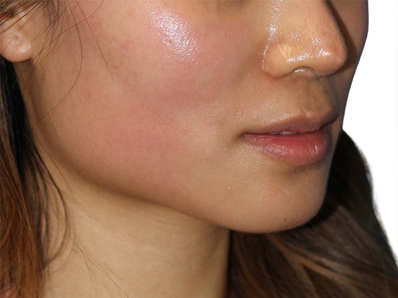 Lip Lift Before & After Gallery - Patient 299577 - Image 3