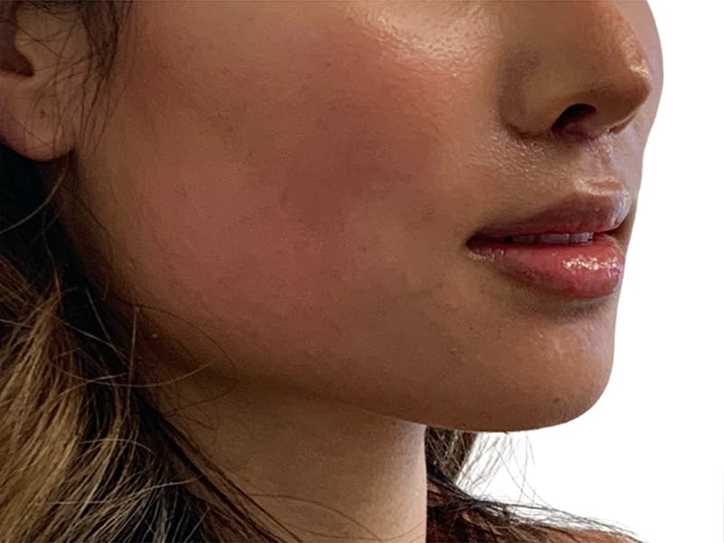 Lip Lift Before & After Gallery - Patient 299577 - Image 4