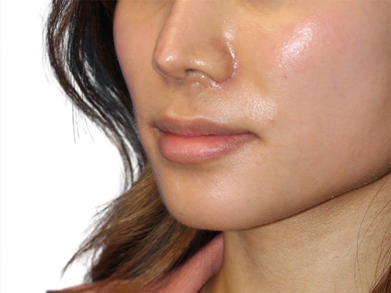 Lip Lift Before & After Gallery - Patient 299577 - Image 5