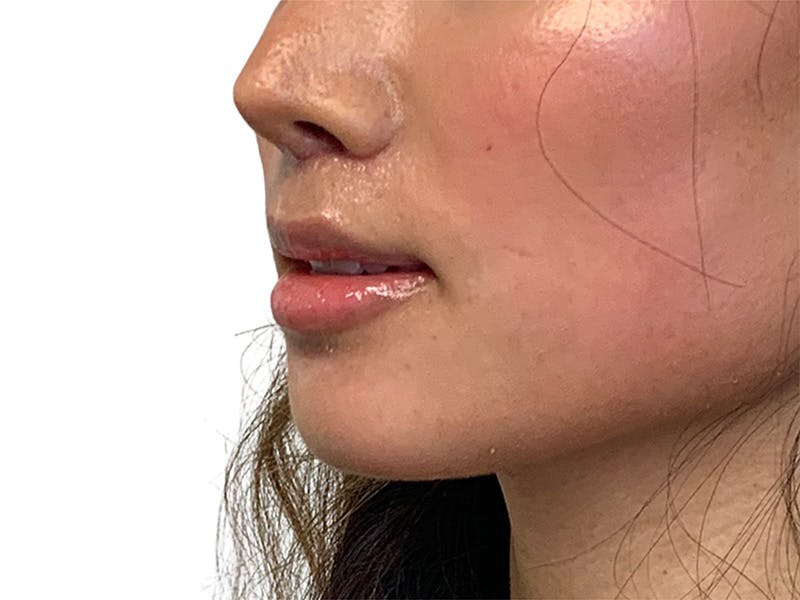 Lip Lift Before & After Gallery - Patient 299577 - Image 6