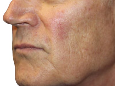 Lip Lift Before & After Gallery - Patient 307709 - Image 1