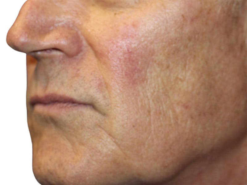 Lip Lift Before & After Gallery - Patient 307709 - Image 1