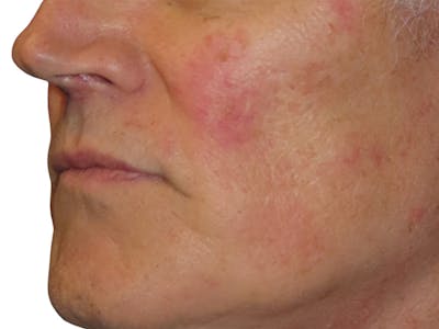 Lip Lift Before & After Gallery - Patient 307709 - Image 2