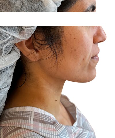 Facial Fat Grafting Before & After Gallery - Patient 138337 - Image 1