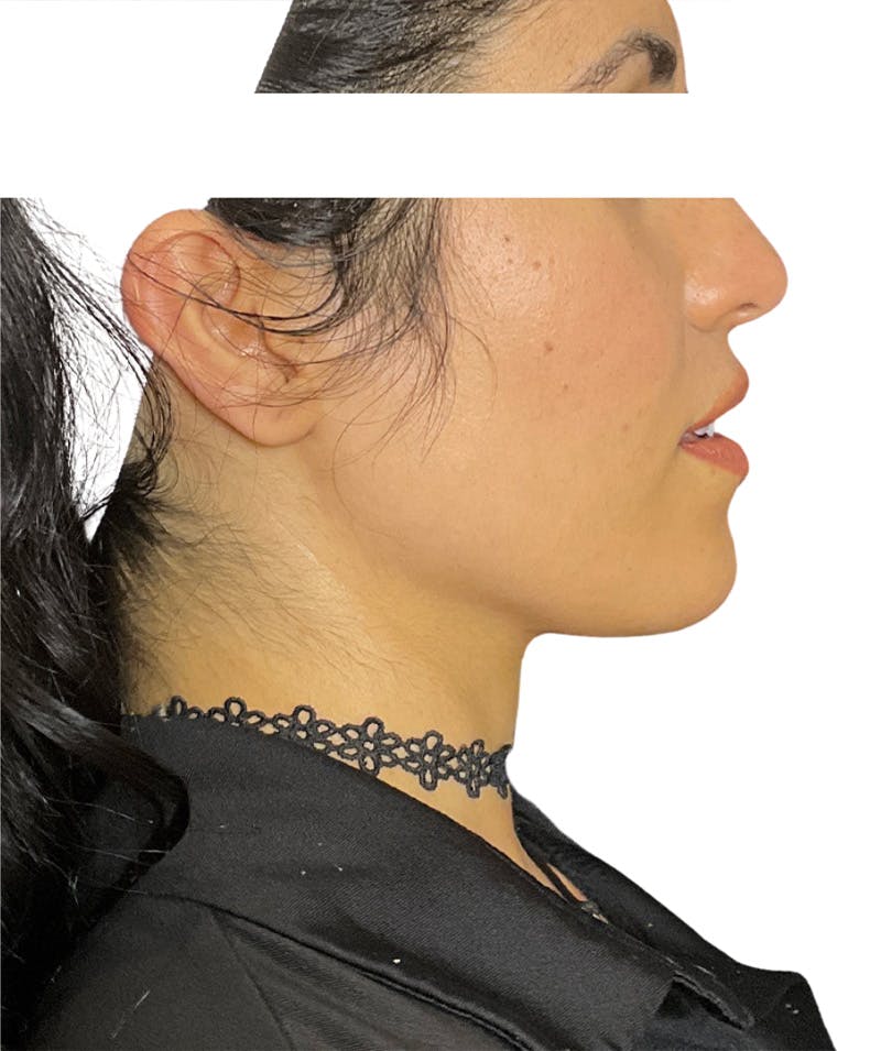 Facial Fat Grafting Before & After Gallery - Patient 138337 - Image 2