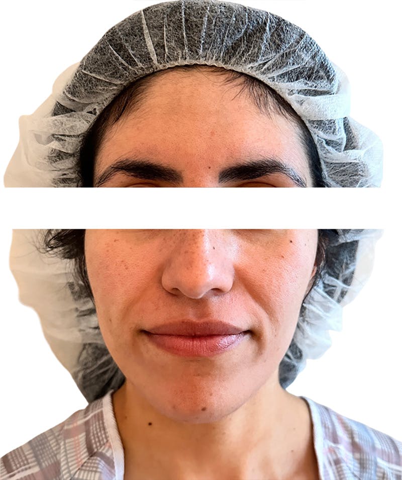 Facial Fat Grafting Before & After Gallery - Patient 138337 - Image 3