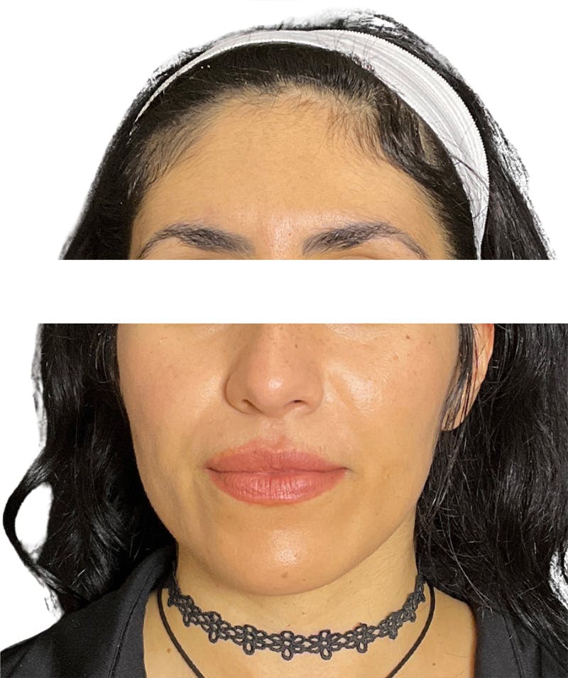 Facial Fat Grafting Before & After Gallery - Patient 138337 - Image 4