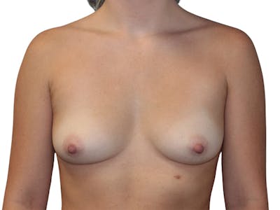 Breast Augmentation Before & After Gallery - Patient 379769 - Image 1