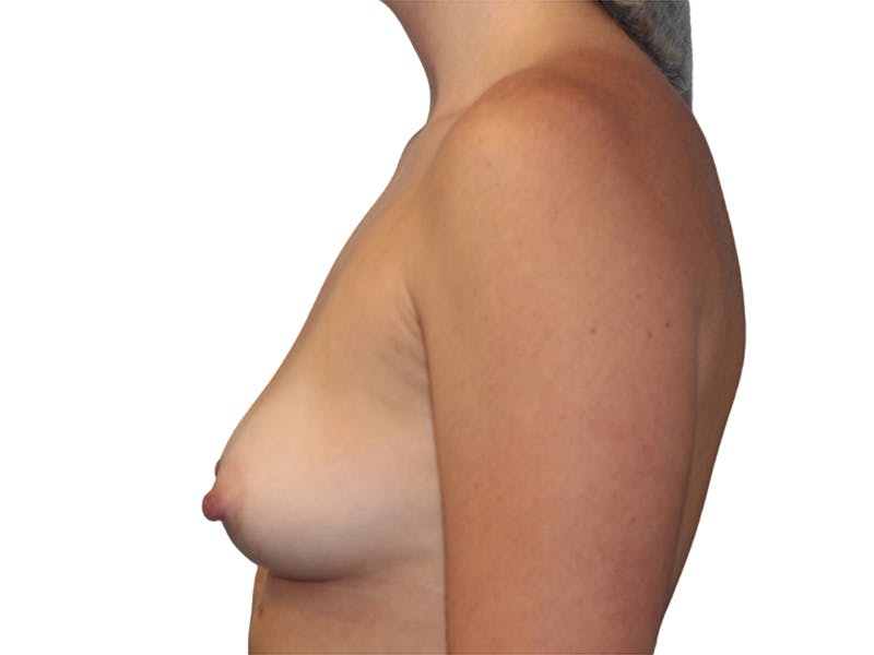 Breast Augmentation Before & After Gallery - Patient 379769 - Image 5