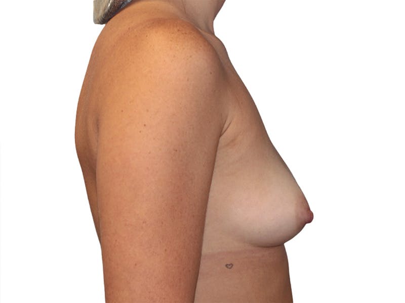 Breast Augmentation Before & After Gallery - Patient 379769 - Image 9