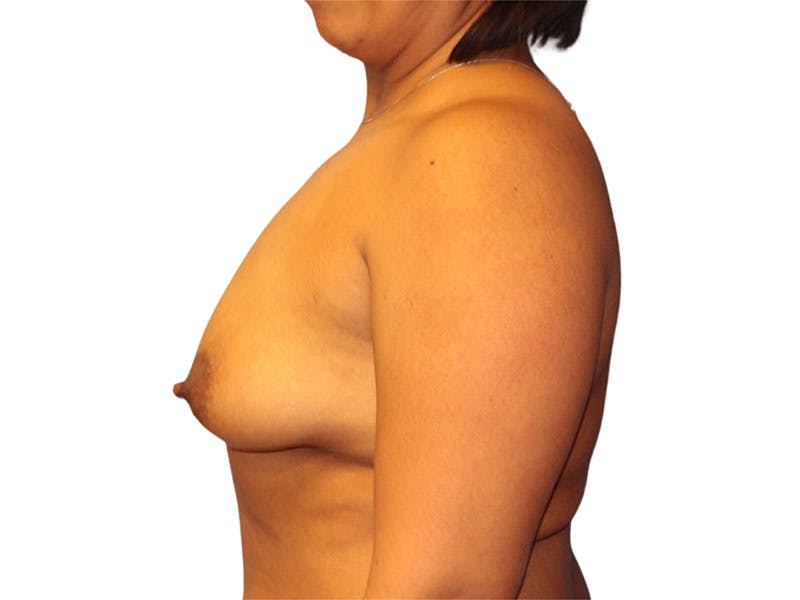 Breast Augmentation Before & After Gallery - Patient 209307 - Image 1