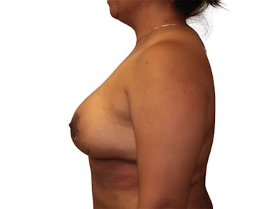 Breast Augmentation Before & After Gallery - Patient 209307 - Image 2