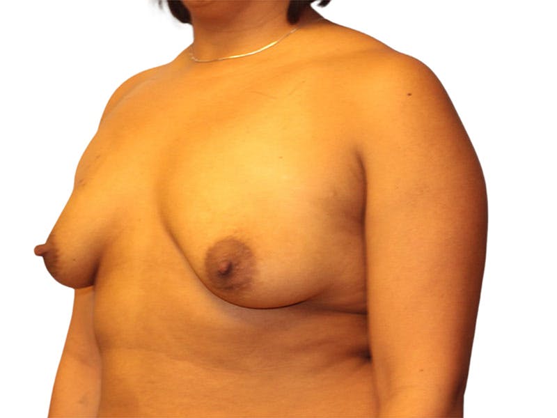 Breast Augmentation Before & After Gallery - Patient 209307 - Image 3