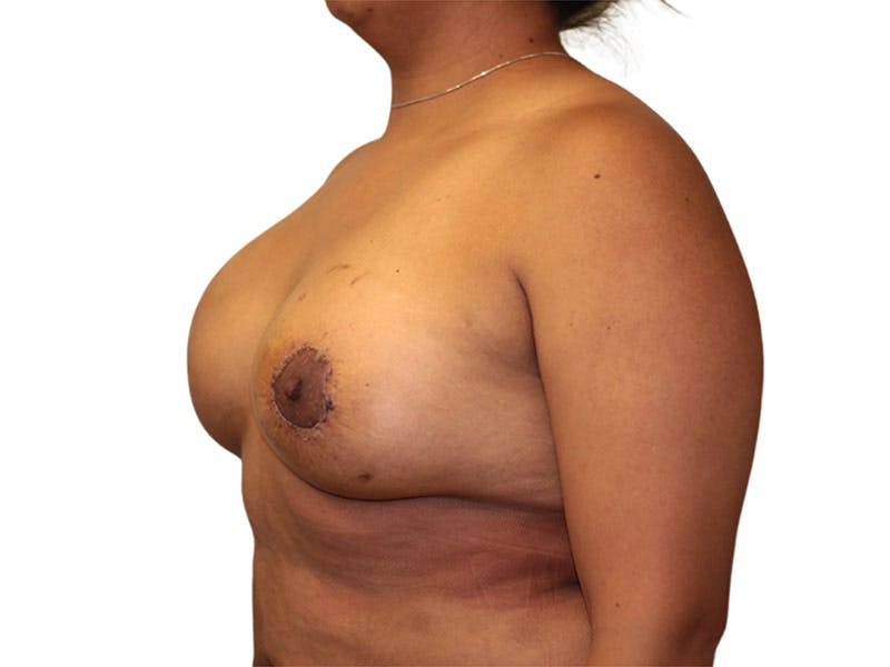 Breast Augmentation Before & After Gallery - Patient 209307 - Image 4