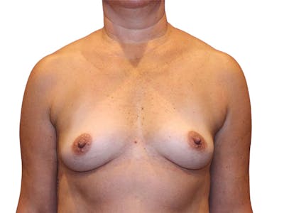 Breast Augmentation Before & After Gallery - Patient 417151 - Image 1