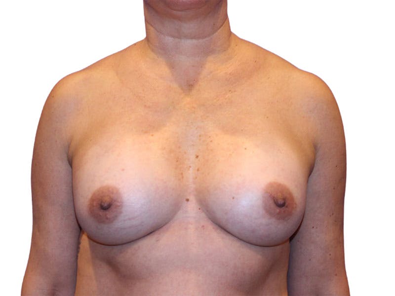 Breast Augmentation Before & After Gallery - Patient 417151 - Image 2