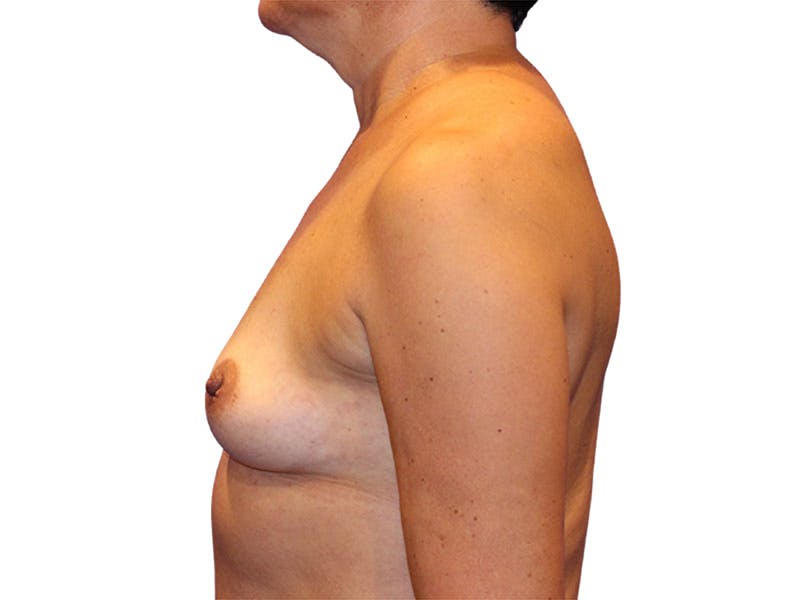 Breast Augmentation Before & After Gallery - Patient 417151 - Image 5
