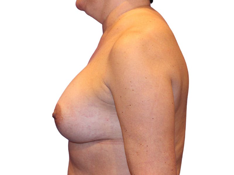 Breast Augmentation Before & After Gallery - Patient 417151 - Image 6