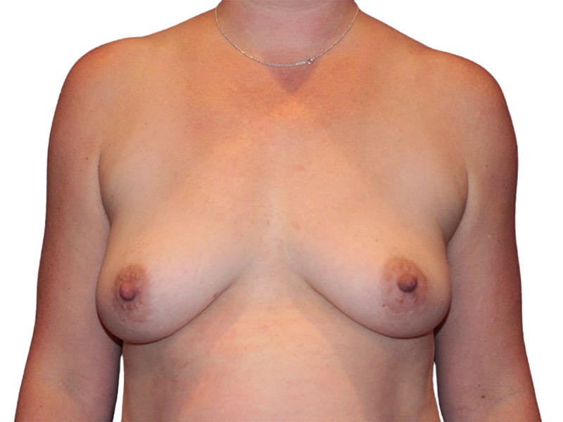Breast Augmentation Before & After Gallery - Patient 938619 - Image 1