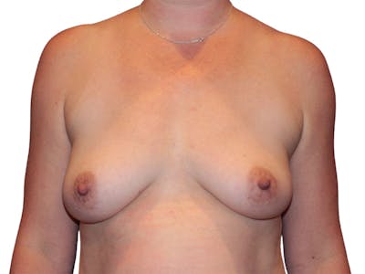Breast Augmentation Before & After Gallery - Patient 938619 - Image 1