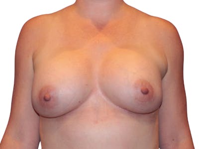 Breast Augmentation Before & After Gallery - Patient 938619 - Image 2