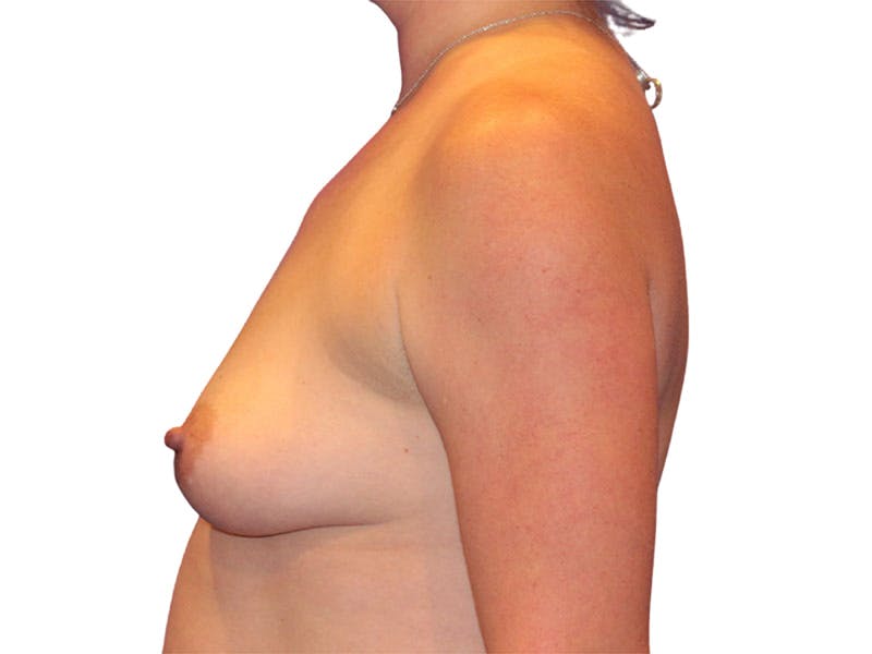 Breast Augmentation Before & After Gallery - Patient 938619 - Image 5