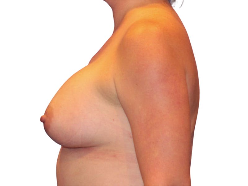 Breast Augmentation Before & After Gallery - Patient 938619 - Image 6
