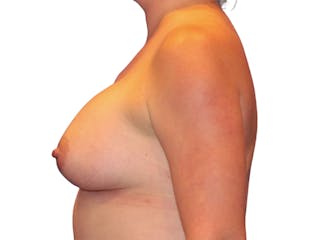 Breast Augmentation Before & After Gallery - Patient 938619 - Image 6
