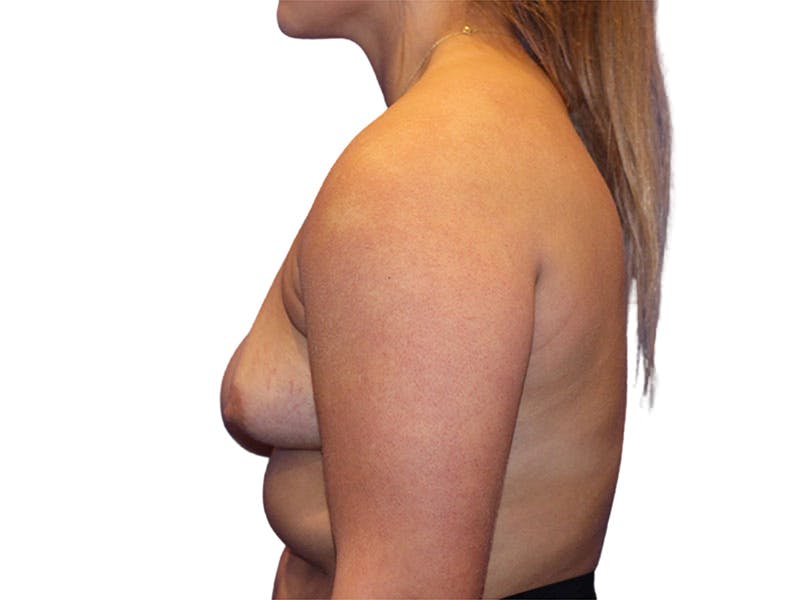 Breast Augmentation Before & After Gallery - Patient 168769 - Image 3