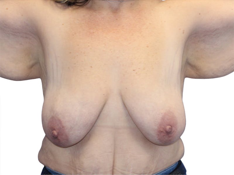 Breast Lift Before & After Gallery - Patient 407053 - Image 1