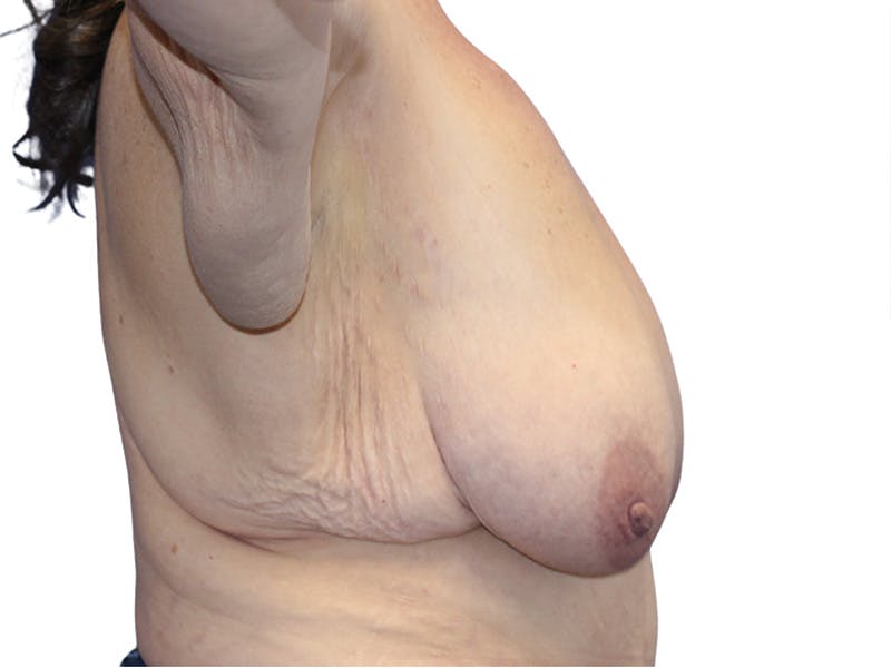 Breast Lift Before & After Gallery - Patient 407053 - Image 3