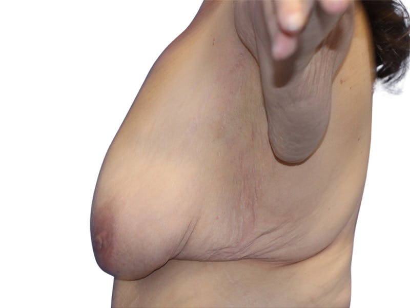 Breast Lift Before & After Gallery - Patient 407053 - Image 5