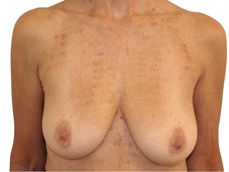 Breast Lift Before & After Gallery - Patient 225162 - Image 1