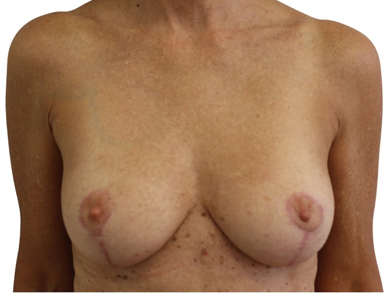 Breast Lift Before & After Gallery - Patient 225162 - Image 2