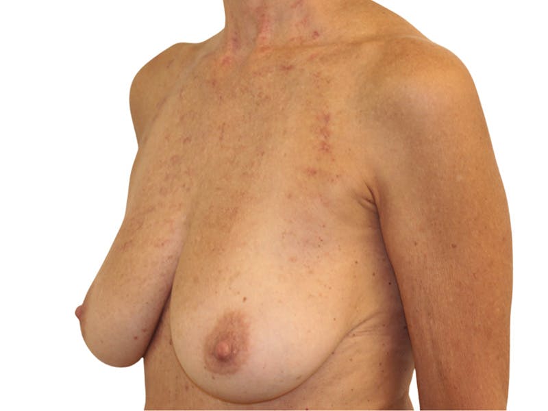 Breast Lift Before & After Gallery - Patient 225162 - Image 3