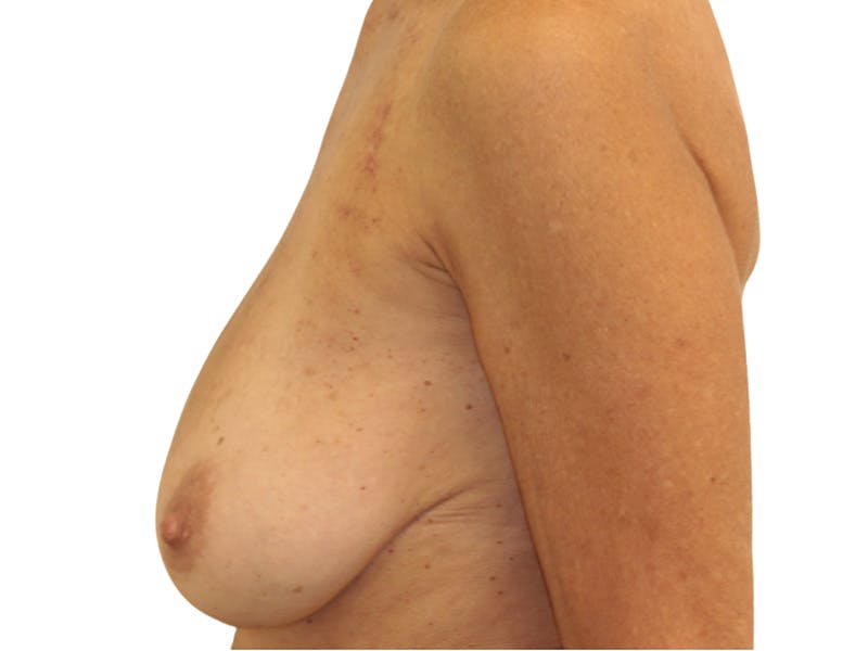 Breast Lift Before & After Gallery - Patient 225162 - Image 5