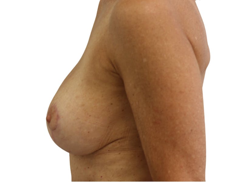 Breast Lift Before & After Gallery - Patient 225162 - Image 6