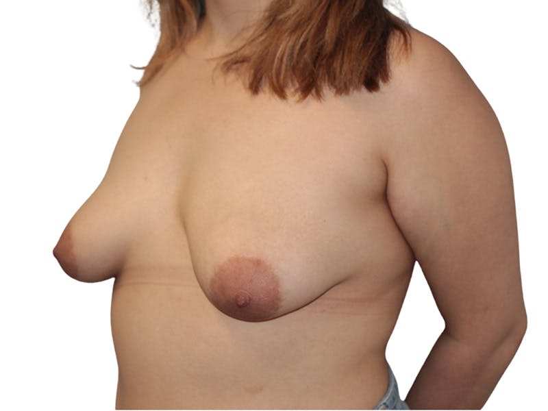 Breast Lift Before & After Gallery - Patient 580538 - Image 1
