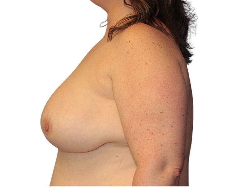 Breast Lift Before & After Gallery - Patient 349553 - Image 6