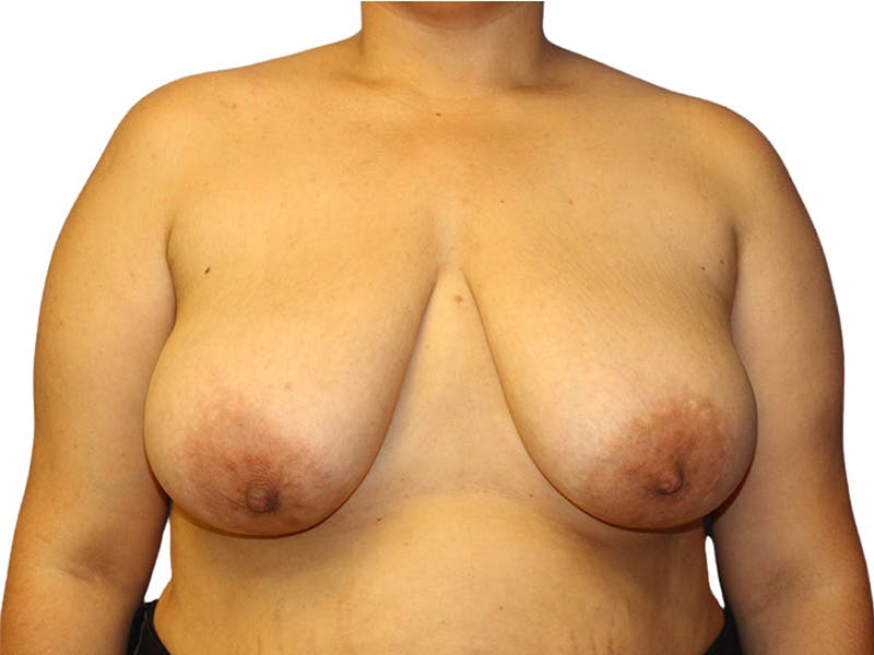 Breast Lift Before & After Gallery - Patient 214358 - Image 1