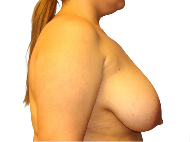 Breast Lift Before & After Gallery - Patient 214358 - Image 3