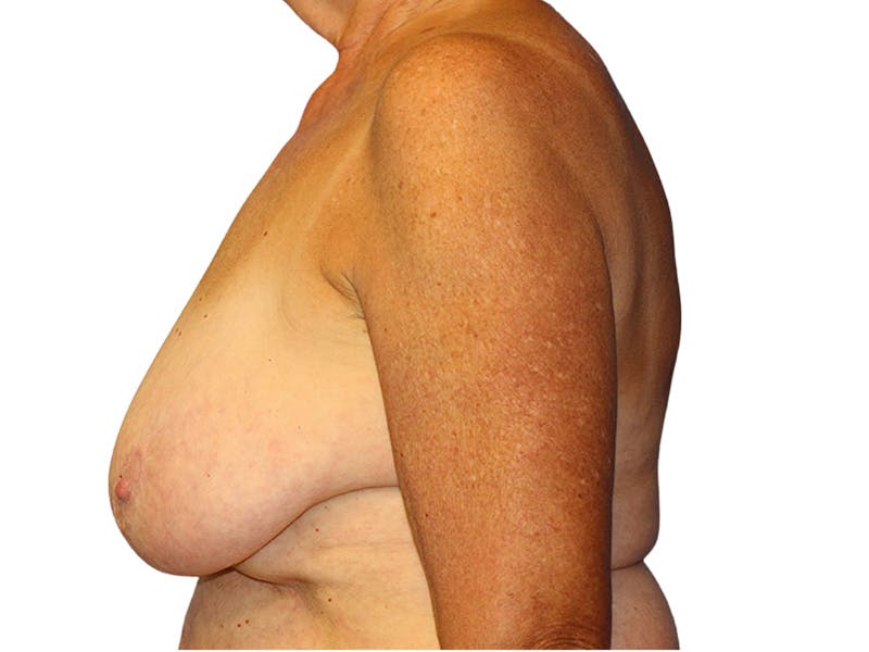 Breast Lift Before & After Gallery - Patient 401127 - Image 1