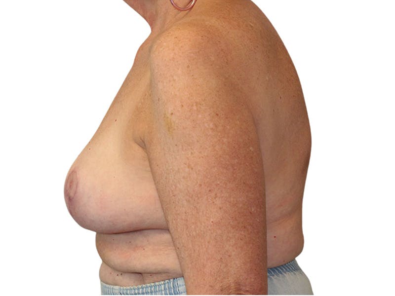 Breast Lift Before & After Gallery - Patient 401127 - Image 2