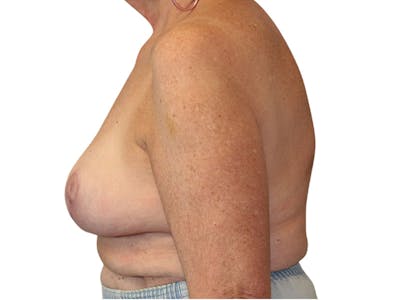 Breast Lift Before & After Gallery - Patient 401127 - Image 2