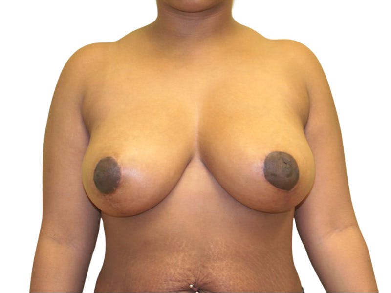 Breast Lift Before & After Gallery - Patient 102418 - Image 2