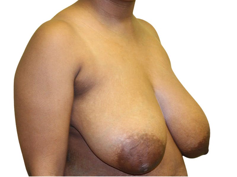 Breast Lift Before & After Gallery - Patient 102418 - Image 3