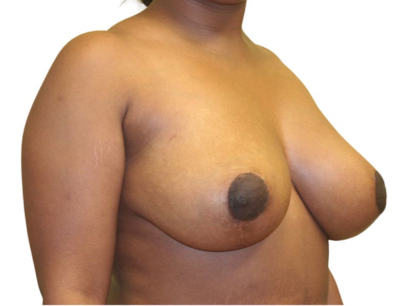 Breast Lift Before & After Gallery - Patient 102418 - Image 4