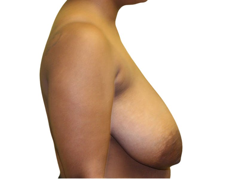 Breast Lift Before & After Gallery - Patient 102418 - Image 5