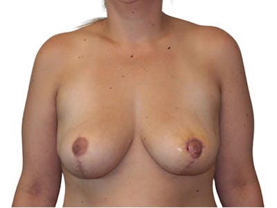 Breast Lift Before & After Gallery - Patient 313365 - Image 2