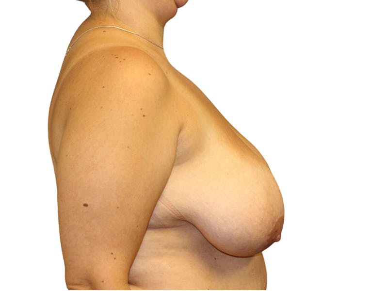 Breast Lift Before & After Gallery - Patient 313365 - Image 5